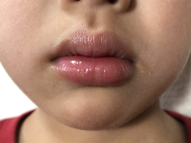 皮膚科で処方された青いリップクリーム 子供の酷い口唇乾燥トラブル ぎゅってweb