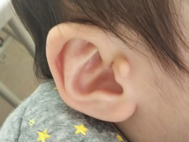 生まれつきの耳の異常 副耳 って何 1歳で切除に踏み切ったワケ ぎゅってweb