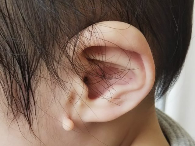 生まれつきの耳の異常 副耳 って何 1歳で切除に踏み切ったワケ ぎゅってweb