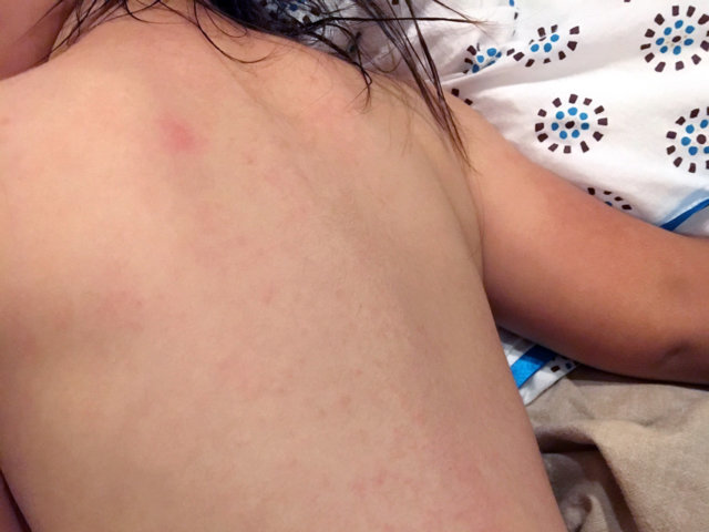 2歳で突発性発疹に イヤイヤ期まっさかりでの不機嫌病は本当につらかった ぎゅってweb