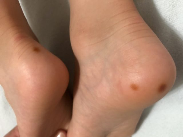 何コレ まさか皮膚がん 突然 5歳息子の足裏にできた赤茶色のシミ ぎゅってweb