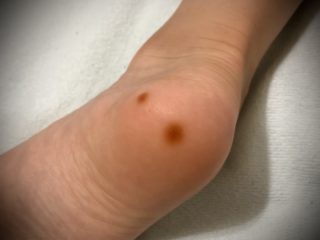 何コレ!?まさか皮膚がん？突然、5歳息子の足裏にできた赤茶色のシミ