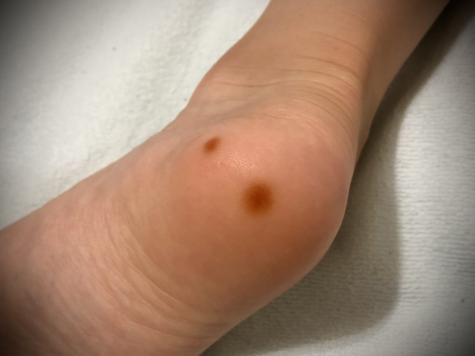 何コレ まさか皮膚がん 突然 5歳息子の足裏にできた赤茶色のシミ ぎゅってweb