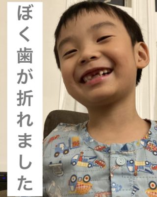 4歳9カ月男子、前歯が折れました。なぜ折れたのか…？